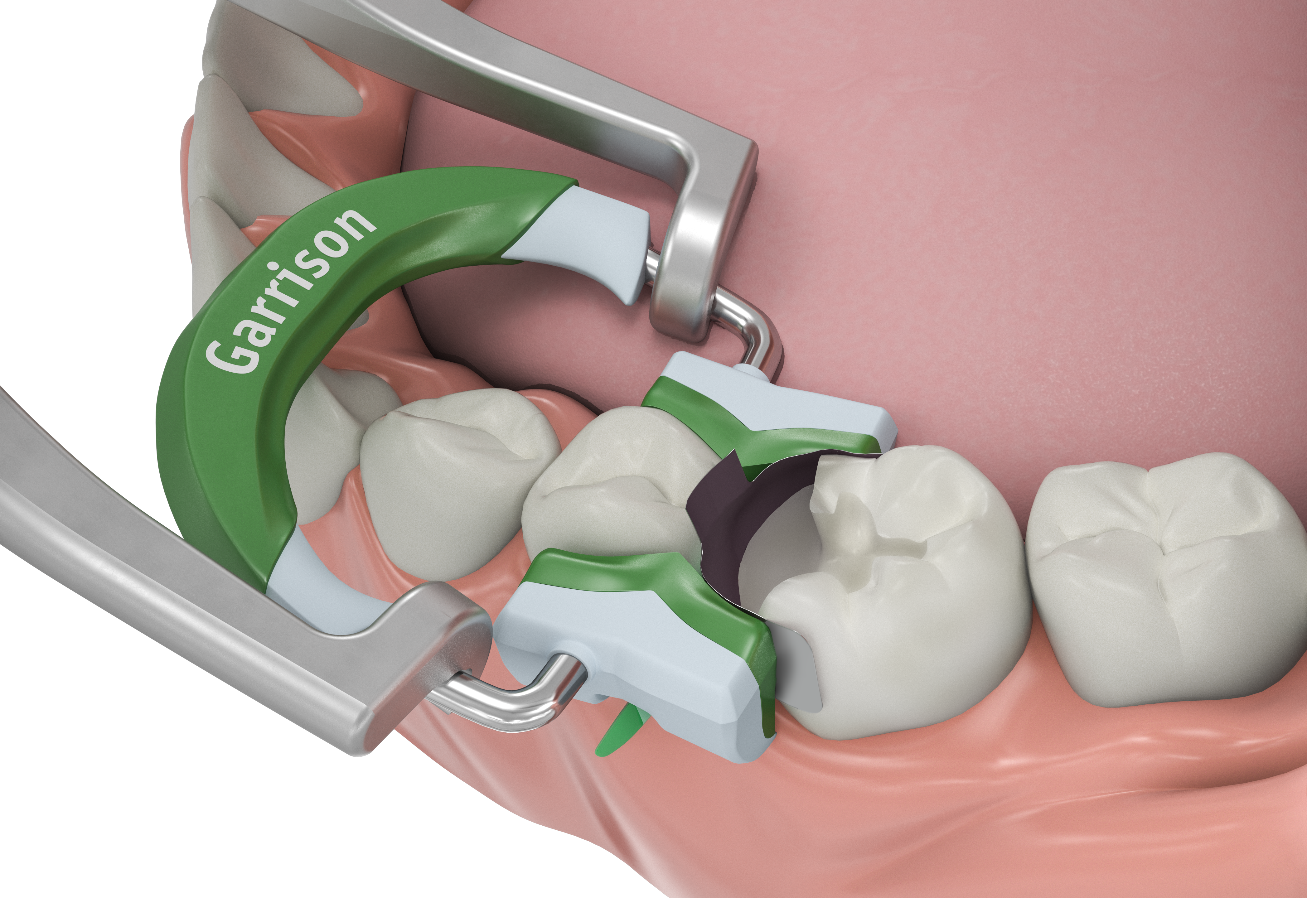 Set Cunei Di Fissaggio Elastico Dentale Matrici Sagomate Sezioni Diga - Foto 9