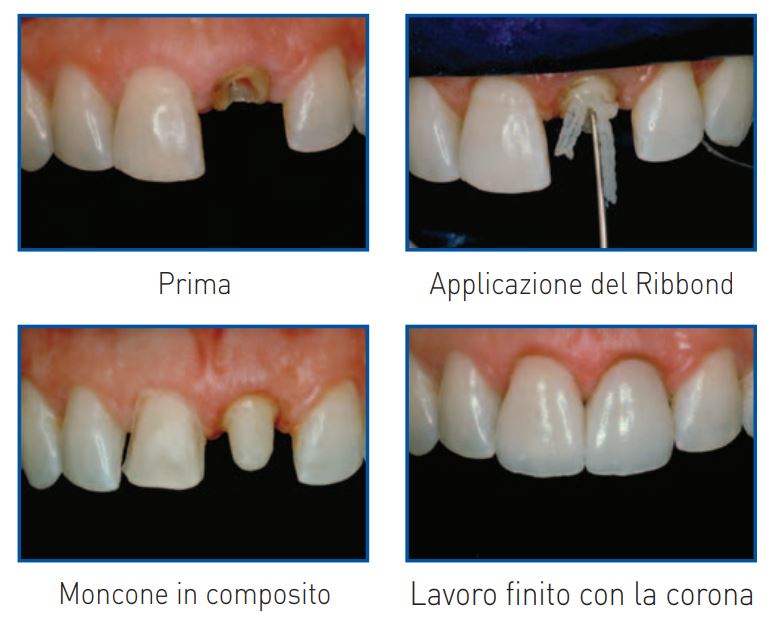 Ribbond Fibra di rinforzo TRIAXIAL Kit Assortito 4 nastri da 15 cm Ilic Dental