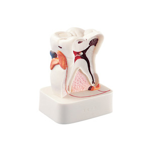 Modello dimostrativo patologie, molare