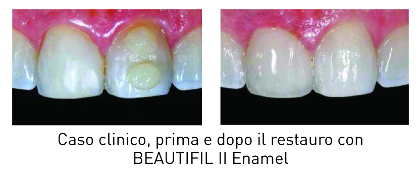 Beautifil II - Siringa - SHOFU - Materiale Per Restauri Estetici - SP - Foto 4