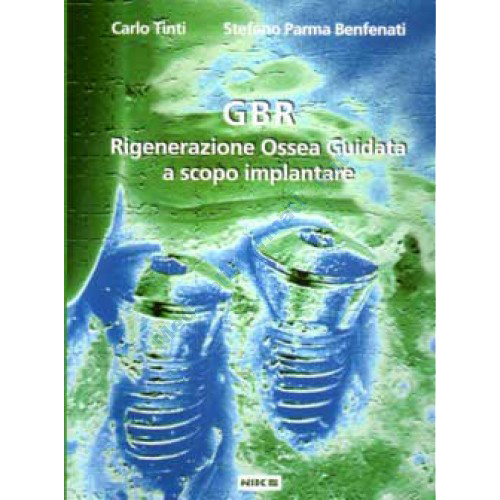GBR Rigenerazione Ossea Guidata a scopo implantare - Carlo Tinti, Stefano Parma Benfenati
