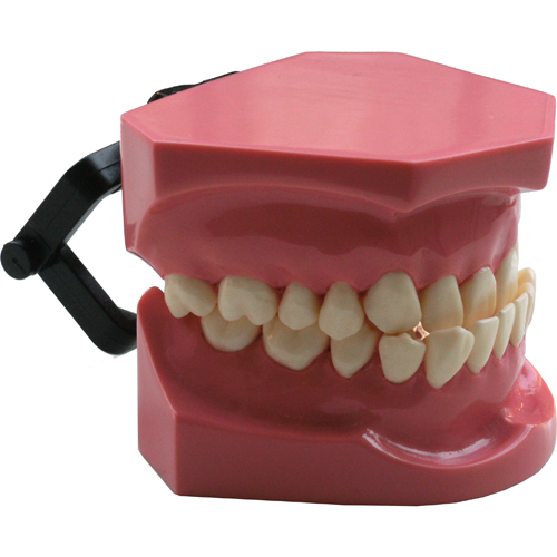 Modello dimostrativo - Ortodonzia Classe 3 morso inverso con brackets, archi e occlusore ROSA