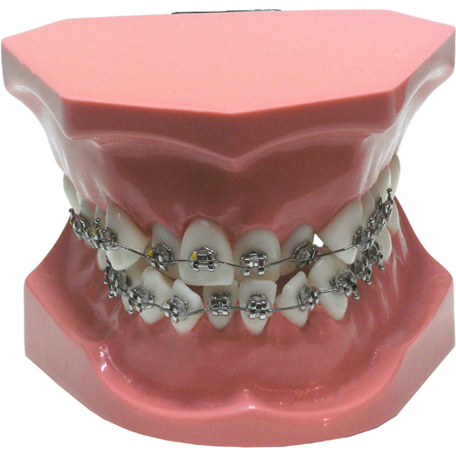 Modello dimostrativo - Ortodonzia Classe 1 affollamento frontale con brackets, archi e occlusore ROSA