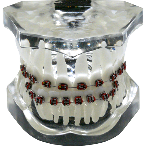 Modello dimostrativo - Ortodonzia Classe 3 morso inverso con brackets, archi e occlusore TRASPARENTE