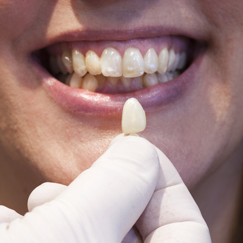 Premolari Superiori - Policarbonato Opaco - Guida Forme Selecta con 10 corone  